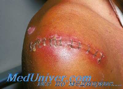 послеоперационные раневые инфекции