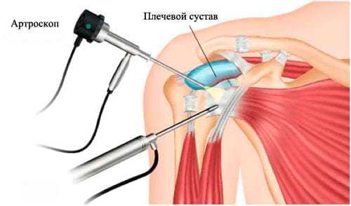 артроскопия