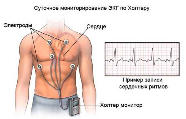 Суточное мониторирование ЭКГ по Холтеру