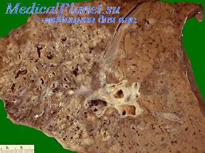 развитие фтизиохирургии