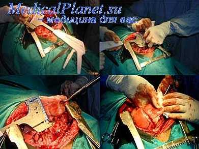 фтизиохирургия