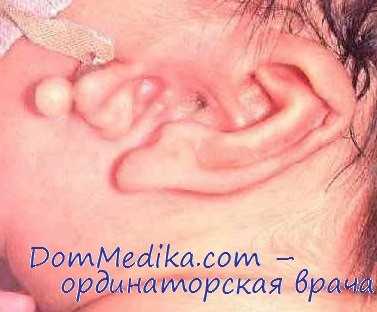 пороки развития уха