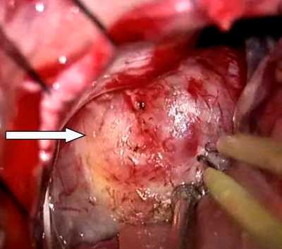Невринома слухового нерва (шваннома)