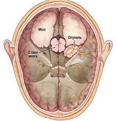 Невринома слухового нерва (шваннома)
