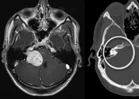 Невринома слухового нерва (шваннома)