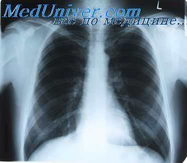 истощение фиксажа в рентгенологии