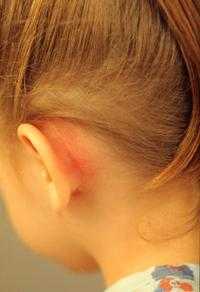 ОСТРЫЙ МАСТОИДИТ.jpg