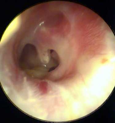 ОСТРЫЙ МАСТОИДИТ2.jpg