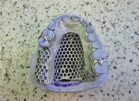 Рис. 7. Цельнолитой каркас съемного протеза на модели.