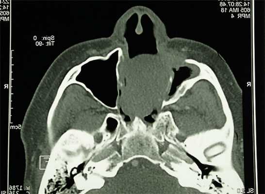 Рис. 1. Хондрома верхней челюсти.