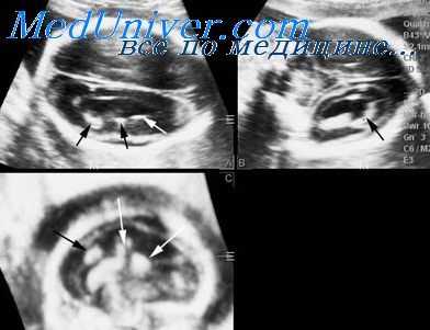 тератома шеи