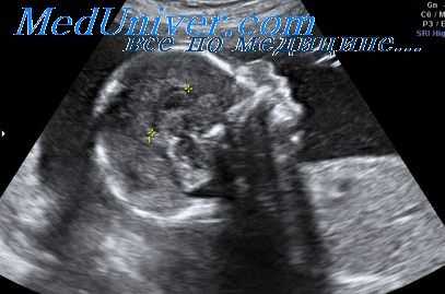 кистозная гигрома