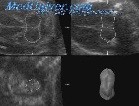 тератома шеи