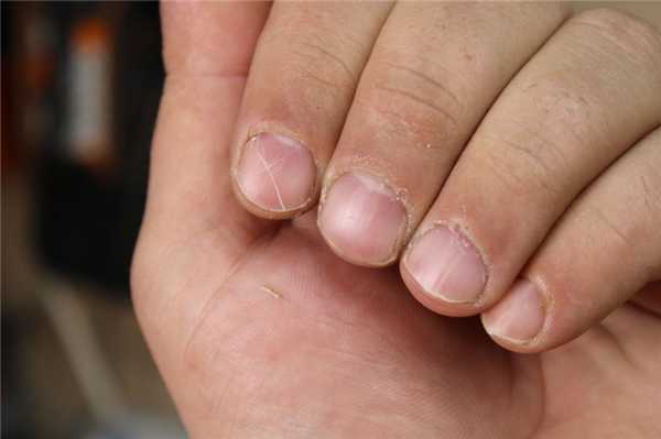 Лечение заусенцев