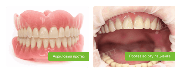 акриловый протез