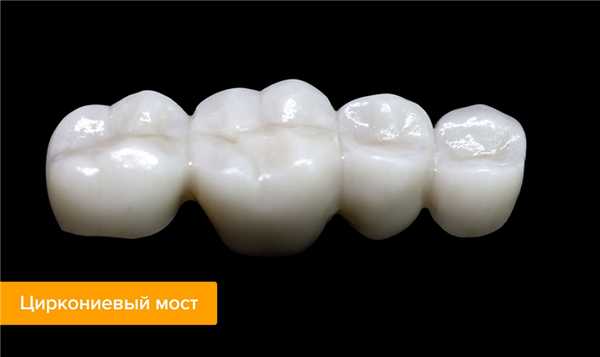 Фото циркониевого моста