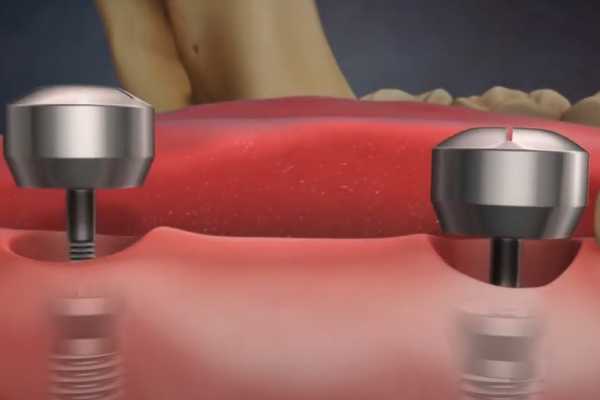 Установка моста на импланты