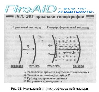 признаки гипертрофии миокарда