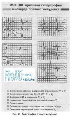 признаки гипертрофии миокарда правого желудочка