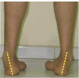 Деформации стоп