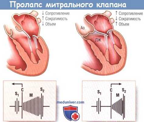 Аускультация при пролапсе митрального клапана (ПМК)