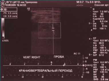 Рис. 4. Снижение кровотока по правой ПА на уровне краниовертебрального перехода при выполнении функциональных проб методом ДС
