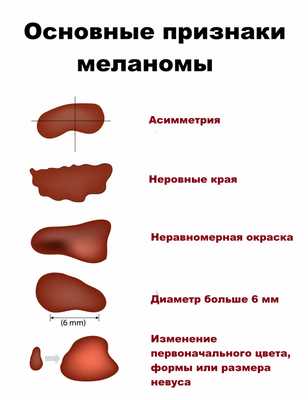 Меланома.jpg