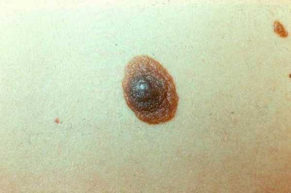 диспластический невус