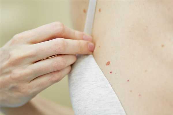 родинки во время беременности