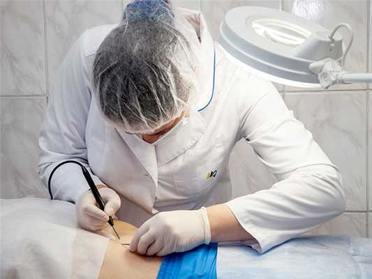 удаление родинки радиоволной