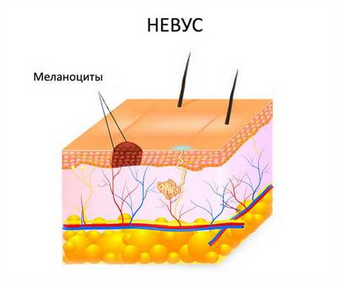 образование родинки из меланоцитов
