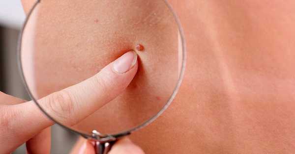 Доброкачественные новообразования кожи