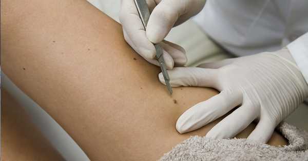 Злокачественные новообразования кожи