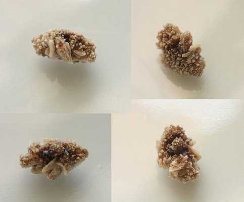 При наличии в моче камней, они посылаются в лабораторию для определения химического состава камня