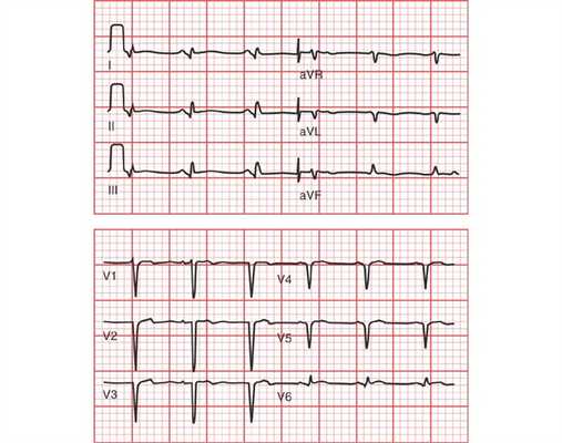 Переднебоковой инфаркт миокарда на ЭКГ