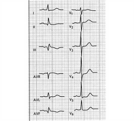 Подострый инфаркт миокарда на ЭКГ