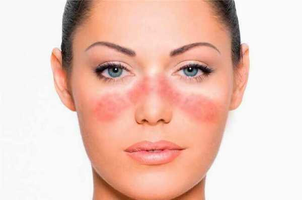 Системная красная волчанка: особенности диагностики и лечения