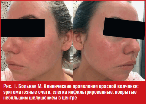 Больная М. Клинические проявления красной волчанки: эритематозные очаги, слегка инфильтрированные, покрытые небольшим шелушением в центре
