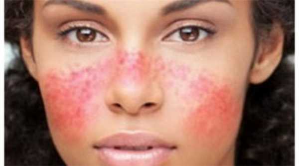 Красная волчанка