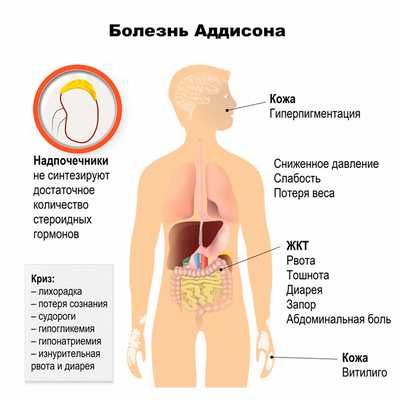 Аддисонический криз