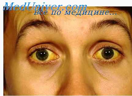 Желтуха при гемохроматозе