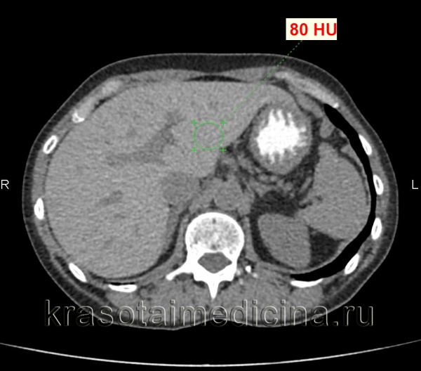 КТ органов брюшной полости. Диффузное повышение плотности печени до 80 ед. Хаунсфилда (преконтрастное изображение) за счет диффузного отложения железа.