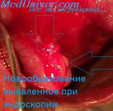 лечение колита