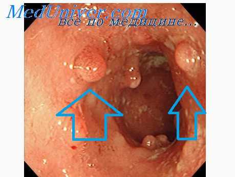 рак прямой кишки