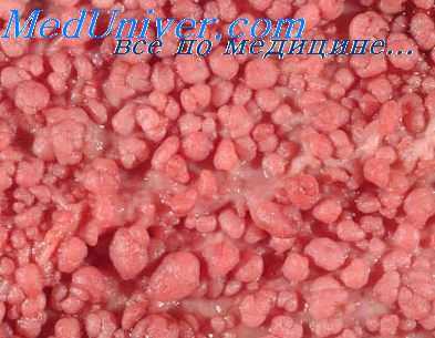 колэктомия