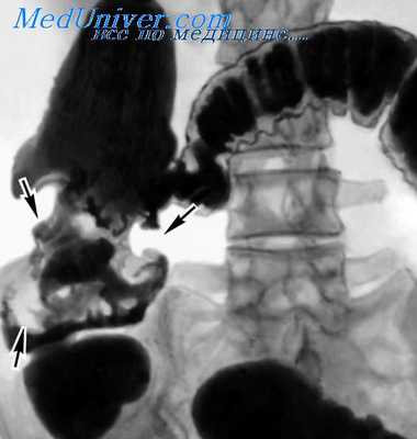 полипоз кишечника