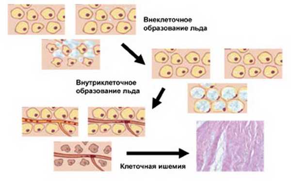 Криоабляция предстательной железы