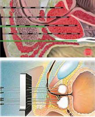 Замораживание рака предстательной железы