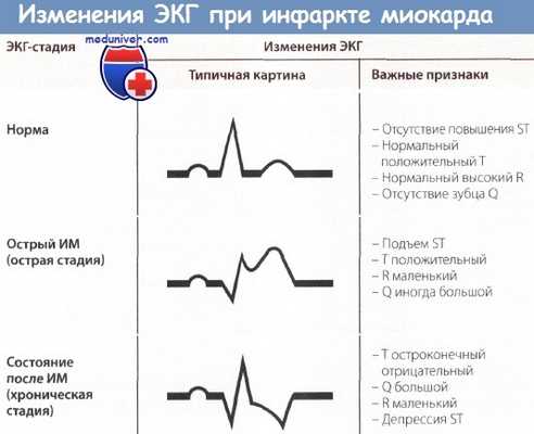 Изменения ЭКГ при инфаркте миокарда