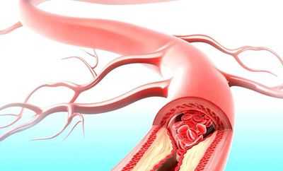 Микроэмболия